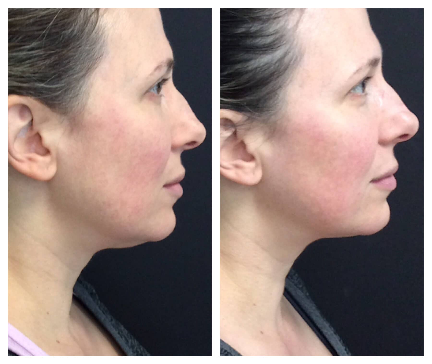 Kybella Before + After Photos - Purely Aesthetics