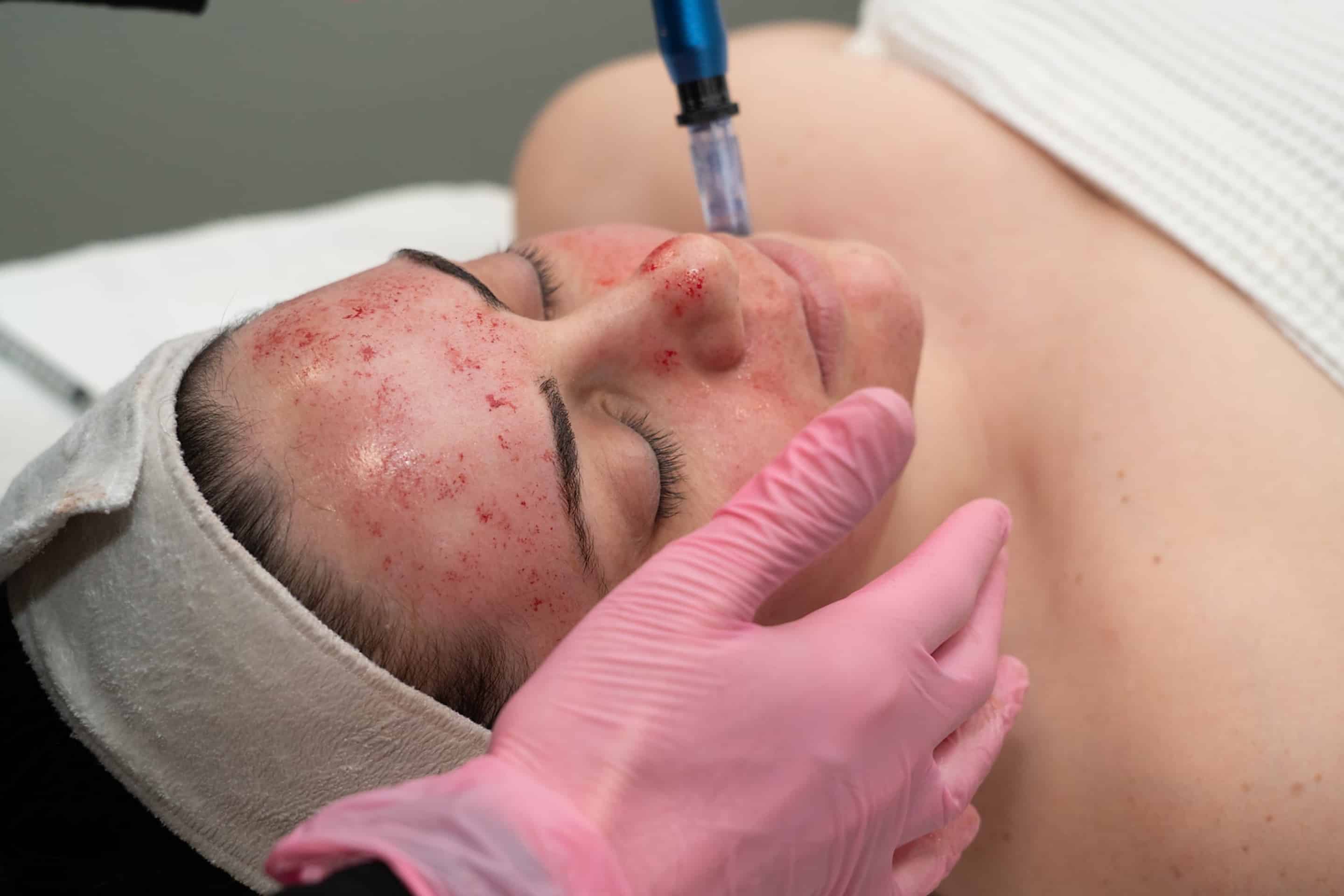 Collagen - RN Esthetics Tightening package